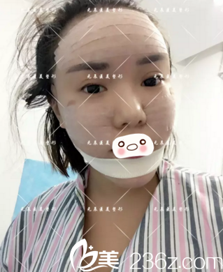 術(shù)后天效果 術(shù)后天效果