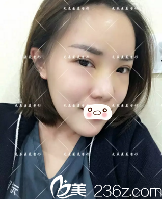 術(shù)后第八天恢復(fù)效果 術(shù)后第八天恢復(fù)效果