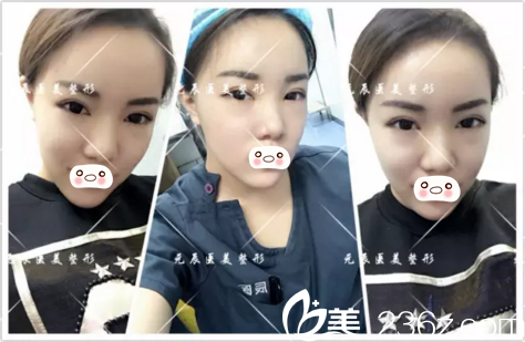 半個(gè)月恢復(fù)程度 半個(gè)月恢復(fù)程度