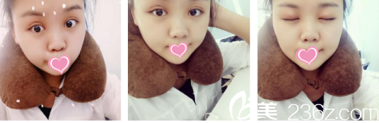 朱健康醫(yī)生雙眼皮<span style=