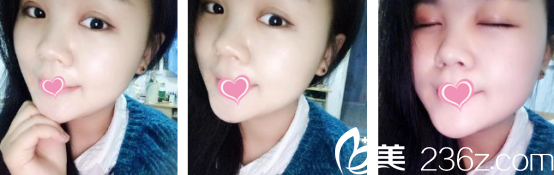 西安葉子醫(yī)院雙眼皮術(shù)后恢復(fù)第10天 西安葉子醫(yī)院雙眼皮術(shù)后恢復(fù)第10天