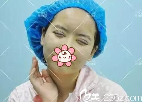 剛做完雙眼皮+眼部提肌整形手術(shù)