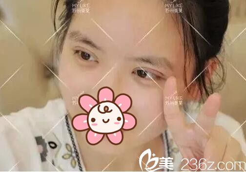 尹飛院長給睜眼費力的小眼睛做了雙眼皮+眼部提肌，看世界都更遼闊了