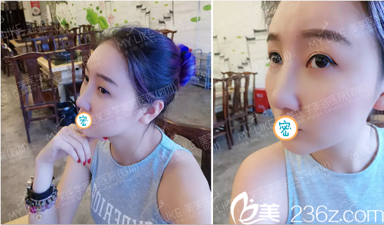 成都美萊謝仕喬面面部埋線提升+線雕隆鼻術(shù)后15天 大家給我的變化打幾分？