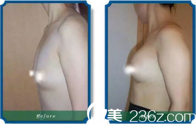 胸部整形前后效果對比