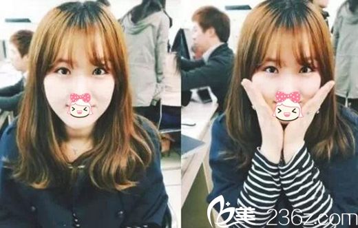 焦作麗人眼鼻整形案例 焦作麗人眼鼻整形案例