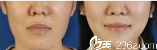 真人案例分享韓國Members整形外科醫(yī)院千智勛下頜角整形效果