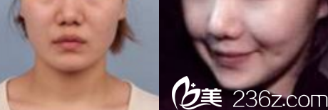 韓國Members整形外科醫(yī)院案例