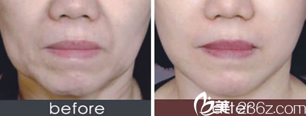 方躍明醫(yī)生注射除皺案例