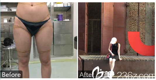深圳南西子鄭舉衛(wèi)大腿小腿吸脂案例