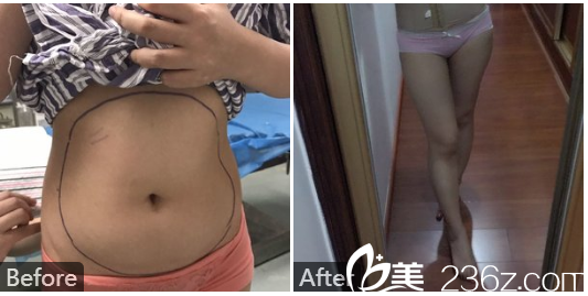 深圳南西子鄭舉衛(wèi)激光溶脂瘦手臂和腰腹部抽脂案例