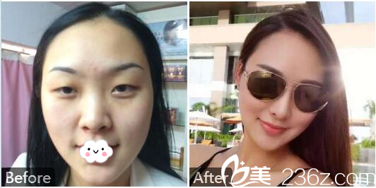 深圳南西子整形醫(yī)生黃藝膨體隆鼻案例