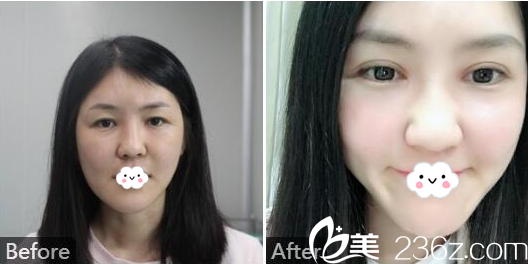 深圳南西子整形醫(yī)院好不好？看黃藝雙眼皮案例