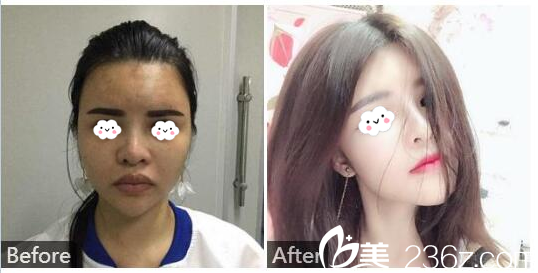 深圳南西子黃藝醫(yī)生厚唇改薄案例