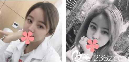 鼻綜合隆鼻術(shù)后15天恢復(fù)效果