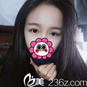 去武漢樂美找車金浩院長面診后當(dāng)場決定做切開雙眼皮 來看看效果吧