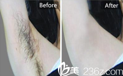腋下脫毛案例 腋下脫毛案例