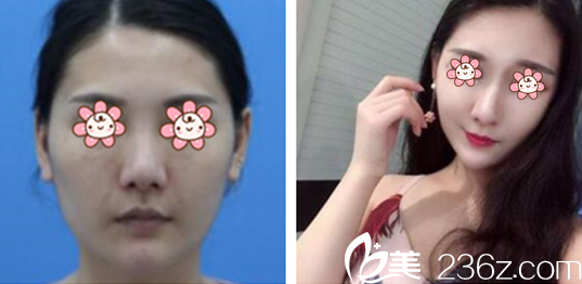 王金紅醫(yī)師面部線雕案例 王金紅醫(yī)師面部線雕案例