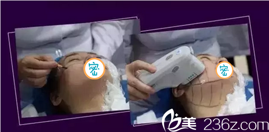 <!--<i data=20240703-sp></i>-->悅美治療過程