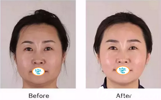 治療術后半個月對比照片