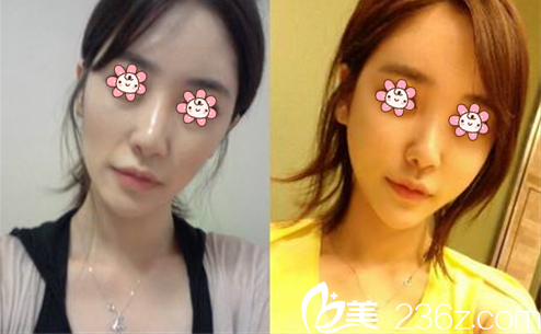 南書宇醫(yī)師面部年輕化案例 南書宇醫(yī)師面部年輕化案例