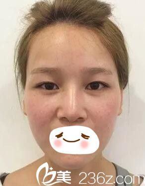 眼鼻修復(fù)術(shù)前效果不明顯 眼鼻修復(fù)術(shù)前效果不明顯