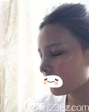 雙眼皮+鼻綜合術(shù)后即刻 雙眼皮+鼻綜合術(shù)后即刻