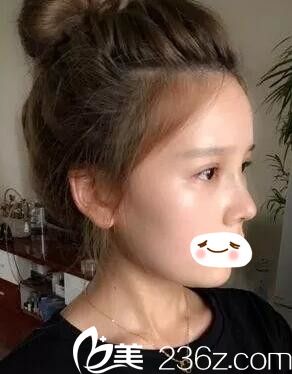 術(shù)后一周眼鼻恢復(fù)中 術(shù)后一周眼鼻恢復(fù)中