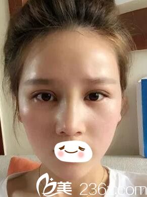 汪涌醫(yī)生眼鼻修復(fù)術(shù)后半個月 汪涌醫(yī)生眼鼻修復(fù)術(shù)后半個月