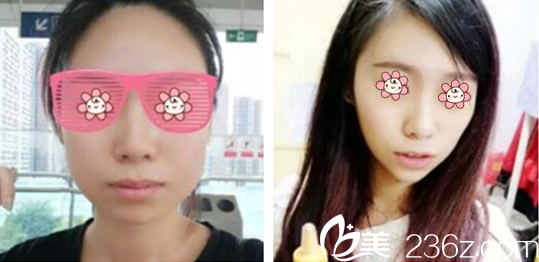 金鄭賢院長瘦臉案例 金鄭賢院長瘦臉案例