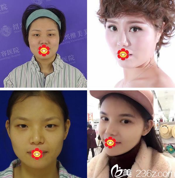 紹興維美整形醫(yī)院雙眼皮真人案例 紹興維美整形醫(yī)院雙眼皮真人案例