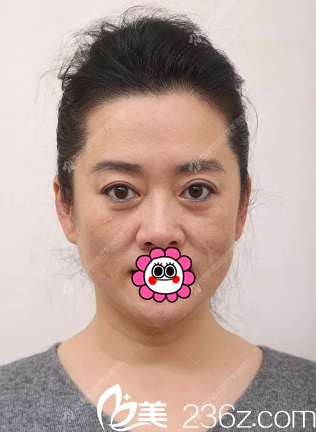 做完皮膚除皺后的效果