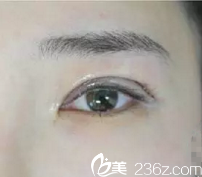 術(shù)后冰敷 術(shù)后冰敷