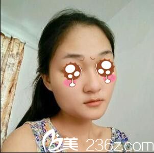 韓國(guó)BAO整形醫(yī)院裴敬太鼻綜合真人案例 韓國(guó)BAO整形醫(yī)院裴敬太鼻綜合真人案例