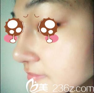 韓國(guó)BAO整形醫(yī)院裴敬太鼻綜合真人案例術(shù)后第十天 韓國(guó)BAO整形醫(yī)院裴敬太鼻綜合真人案例術(shù)后第十天