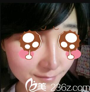 韓國(guó)BAO整形醫(yī)院裴敬太鼻綜合真人案例術(shù)后十五天 韓國(guó)BAO整形醫(yī)院裴敬太鼻綜合真人案例術(shù)后十五天