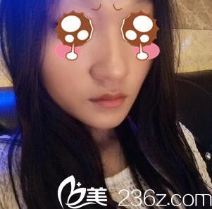 聊聊我在韓國(guó)BAO整形醫(yī)院裴敬太做的鼻綜合一個(gè)月的心里路程