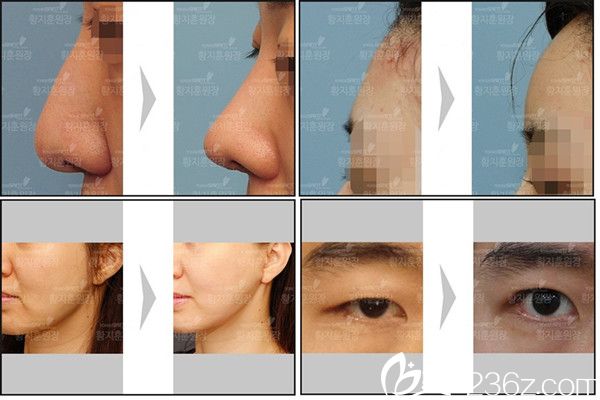 韓國(guó)延世Saint整形外科案例 韓國(guó)延世Saint整形外科案例