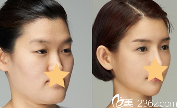 京美唐愛東醫(yī)生微拉美面部提升前后效果對比圖