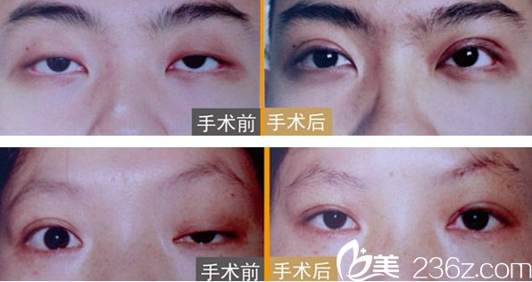 京美整形呂廣旭雙眼皮+上瞼下垂矯正修復(fù)效果