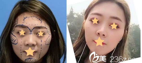 呼市京美朱京成醫(yī)生自體脂肪移植填充面部三個月恢復(fù)效果