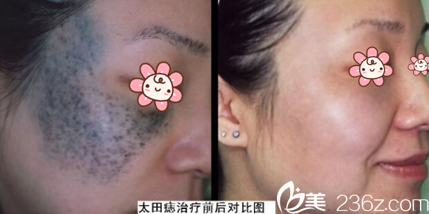 馬艷冬醫(yī)師太田痣祛除案例 馬艷冬醫(yī)師太田痣祛除案例