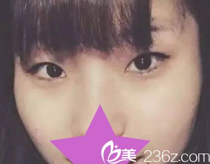 呼市京美全切雙眼皮+開眼角前 呼市京美全切雙眼皮+開眼角前