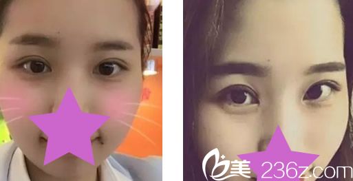 割雙眼皮一個月恢復(fù)效果圖 割雙眼皮一個月恢復(fù)效果圖