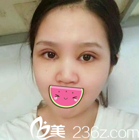 術(shù)后第四天樣子 術(shù)后第四天樣子