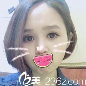 看學(xué)生黨找韓國(guó)美感整形醫(yī)院趙得媛做了韓式雙眼皮+開眼角后，土妞變大眼萌妹!