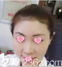 面部脂肪填充北京櫻桃整形改變我的粗糙臉，價格還行