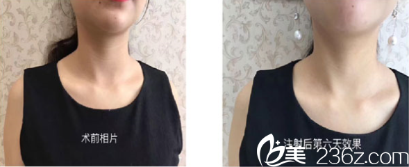 祛頸紋案例1 祛頸紋案例1