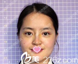 韓式雙眼皮韓式隆鼻術(shù)后第十天的樣子