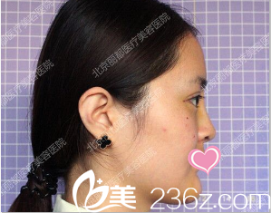 在麗都做雙眼皮隆鼻術(shù)后二十八天的樣子